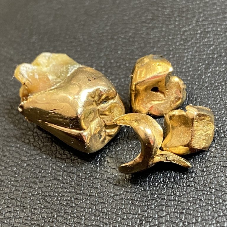 金歯