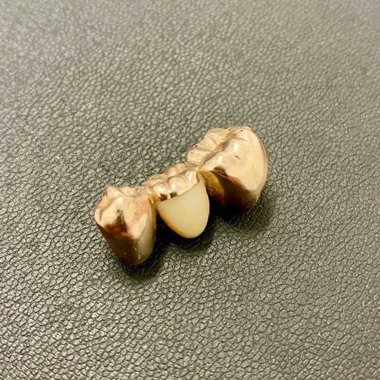 金歯