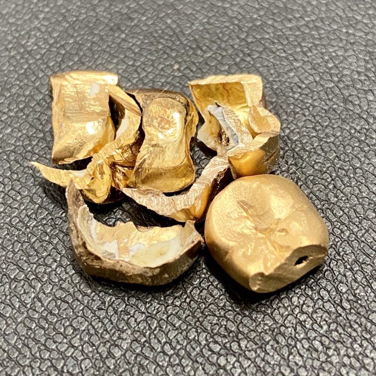 金歯