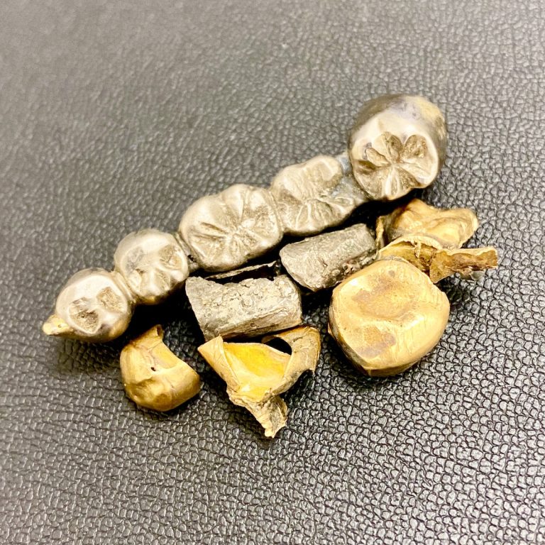 金歯 / 銀歯